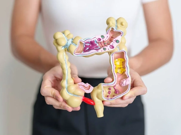 Colon Polyps